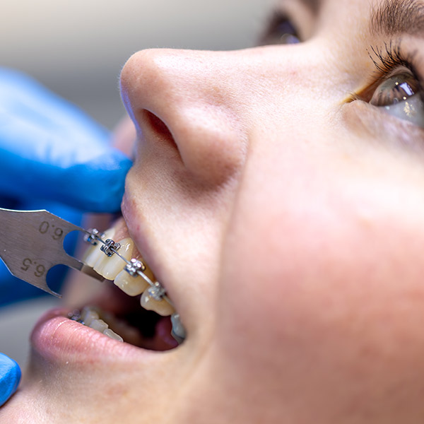 Ortodoncia con Brackets