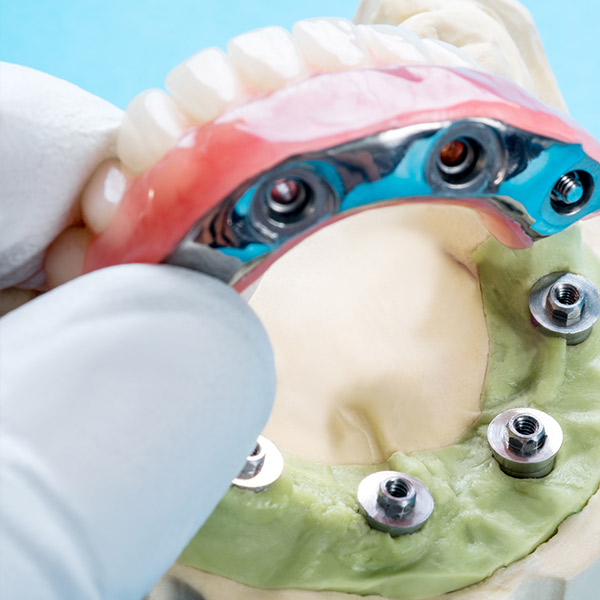 Sobredentaduras sobre implantes